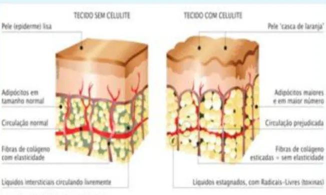 Nutrição e celulite