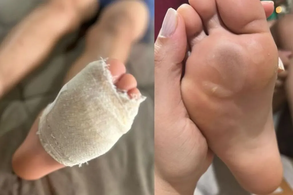 Criança sofre queimaduras nos pés após ser obrigada a jogar futebol descalça em escola de SC