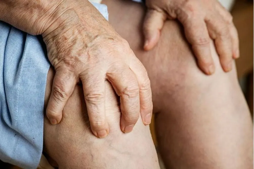 Varizes: causas, prevenção e opções de tratamento